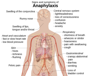 Signs and symptoms of anaphylaxis. Photo taken by Mikael Häggström